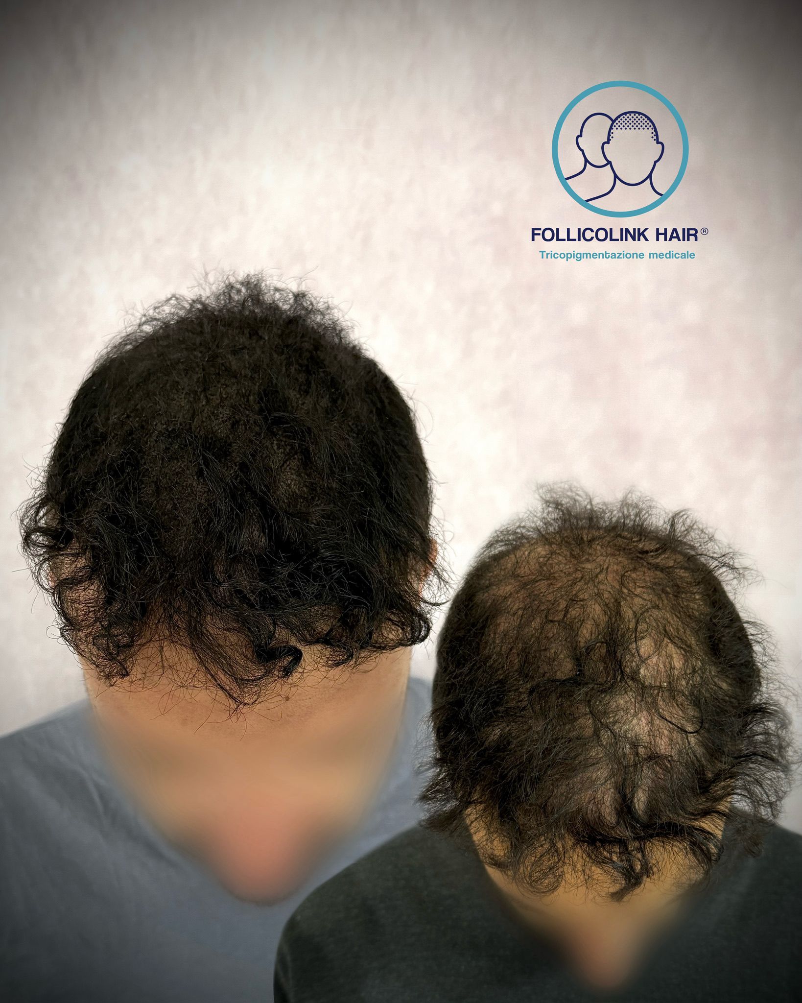 Il caso di Giulio - risultato tricopigmentazione a Catania Follicolink Hair