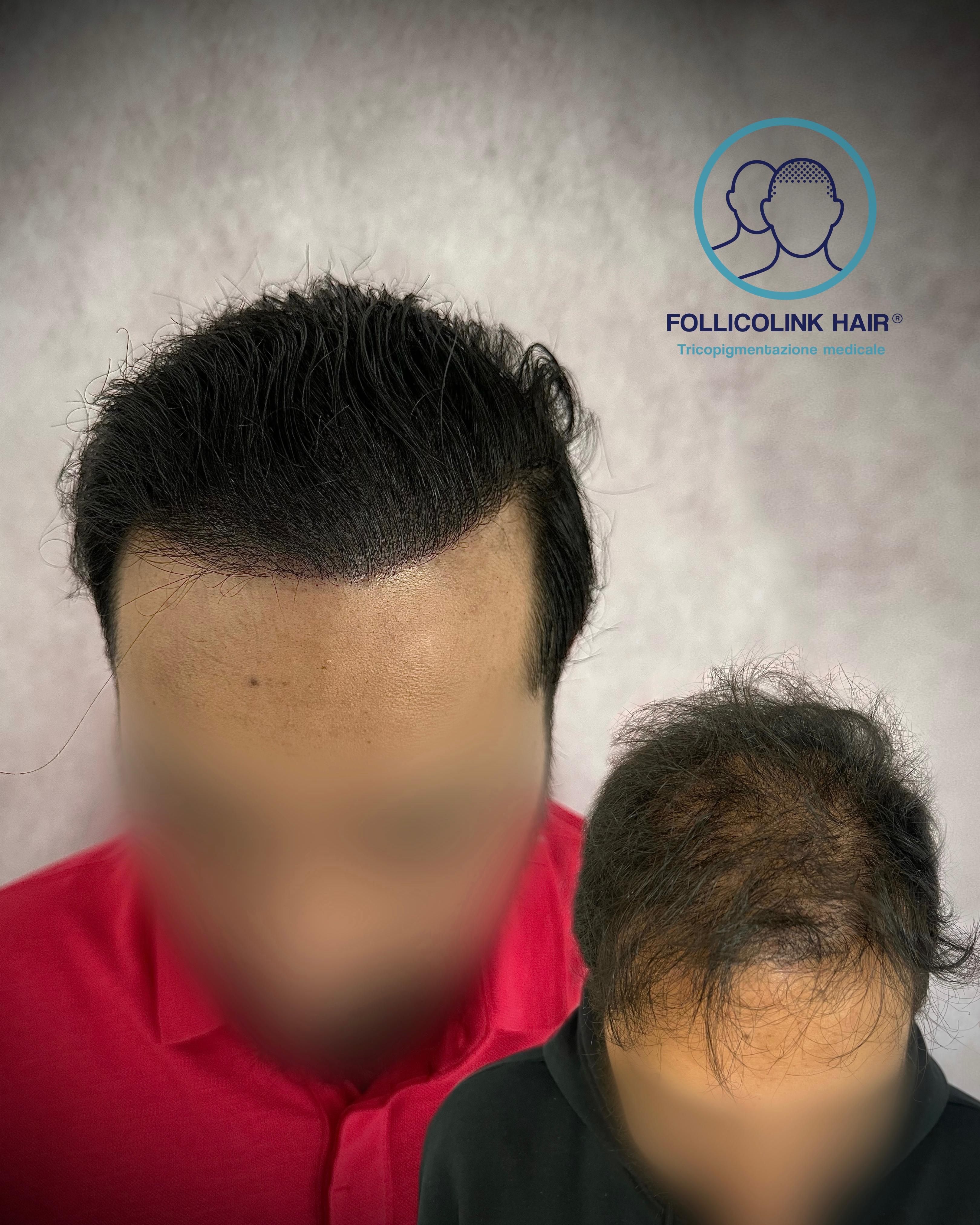 Il caso di Marco - risultato tricopigmentazione a Catania Follicolink Hair