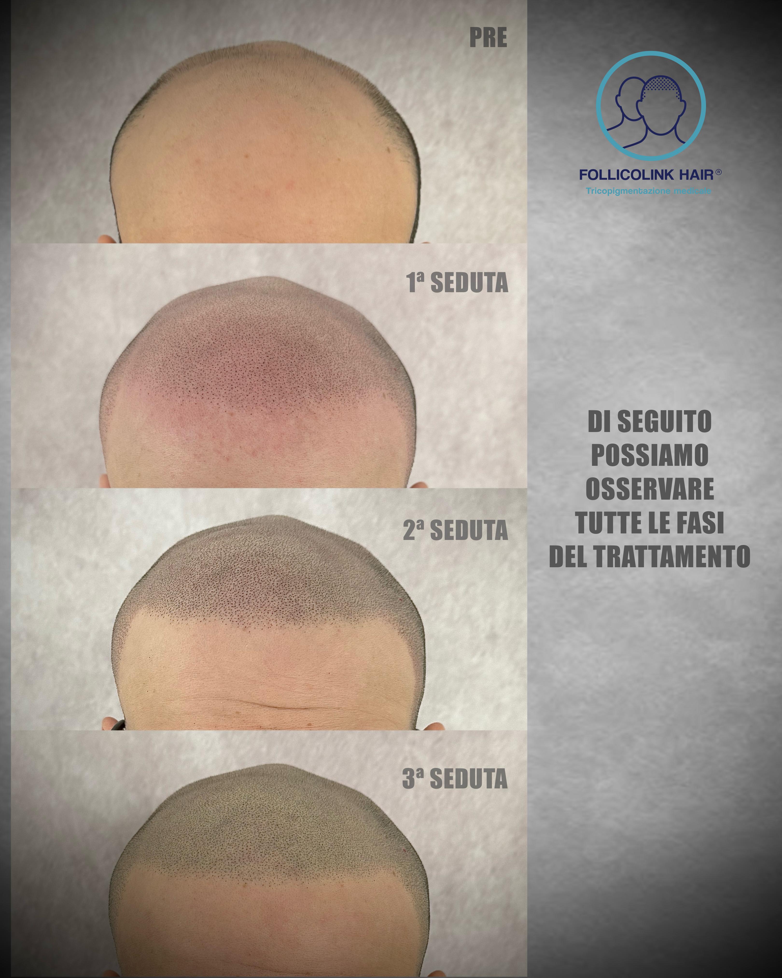 Tutte le fasi del trattamento - risultato tricopigmentazione a Catania Follicolink Hair