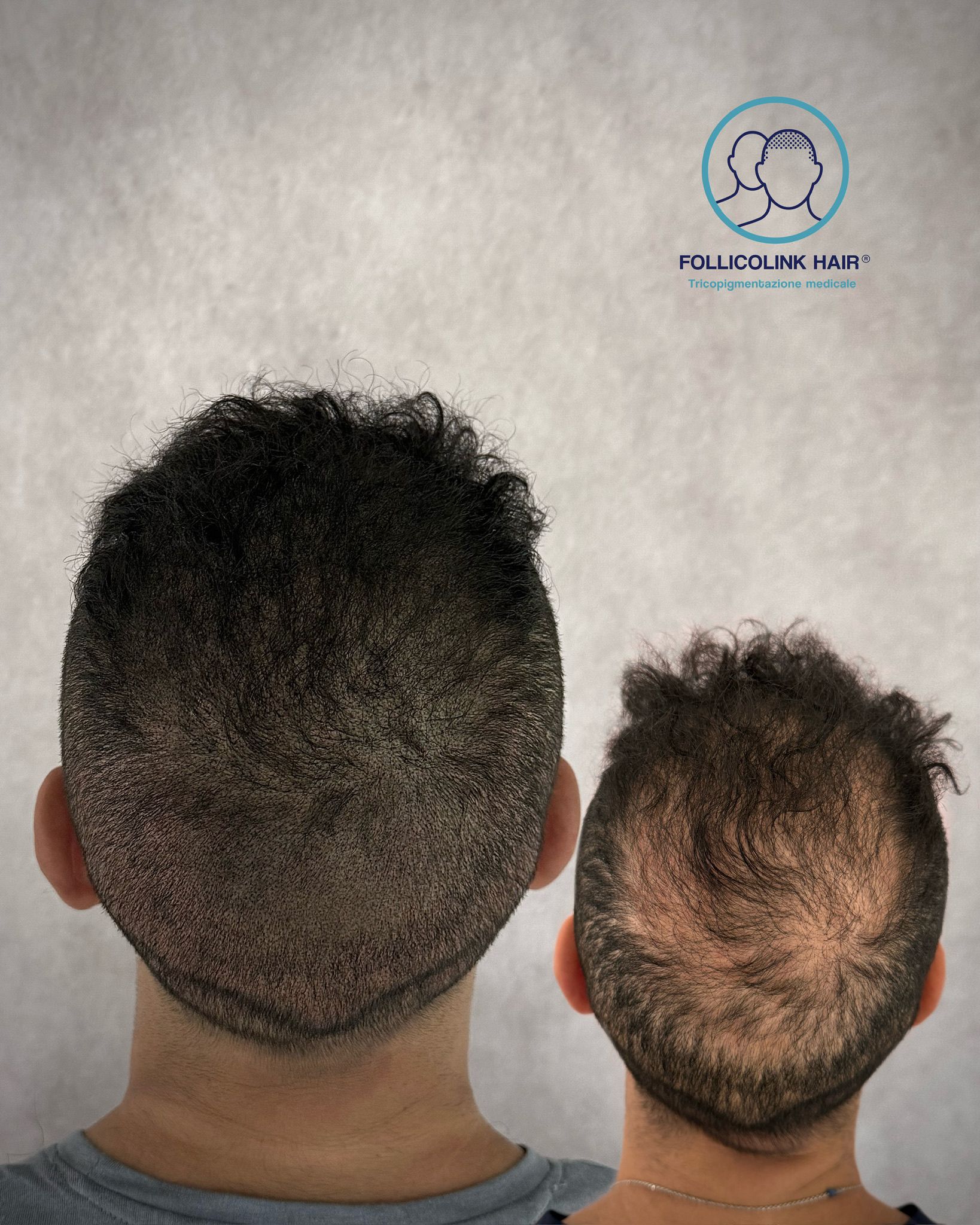 Effetto densità - trattamento di tricopigmentazione a Catania Follicolink Hair