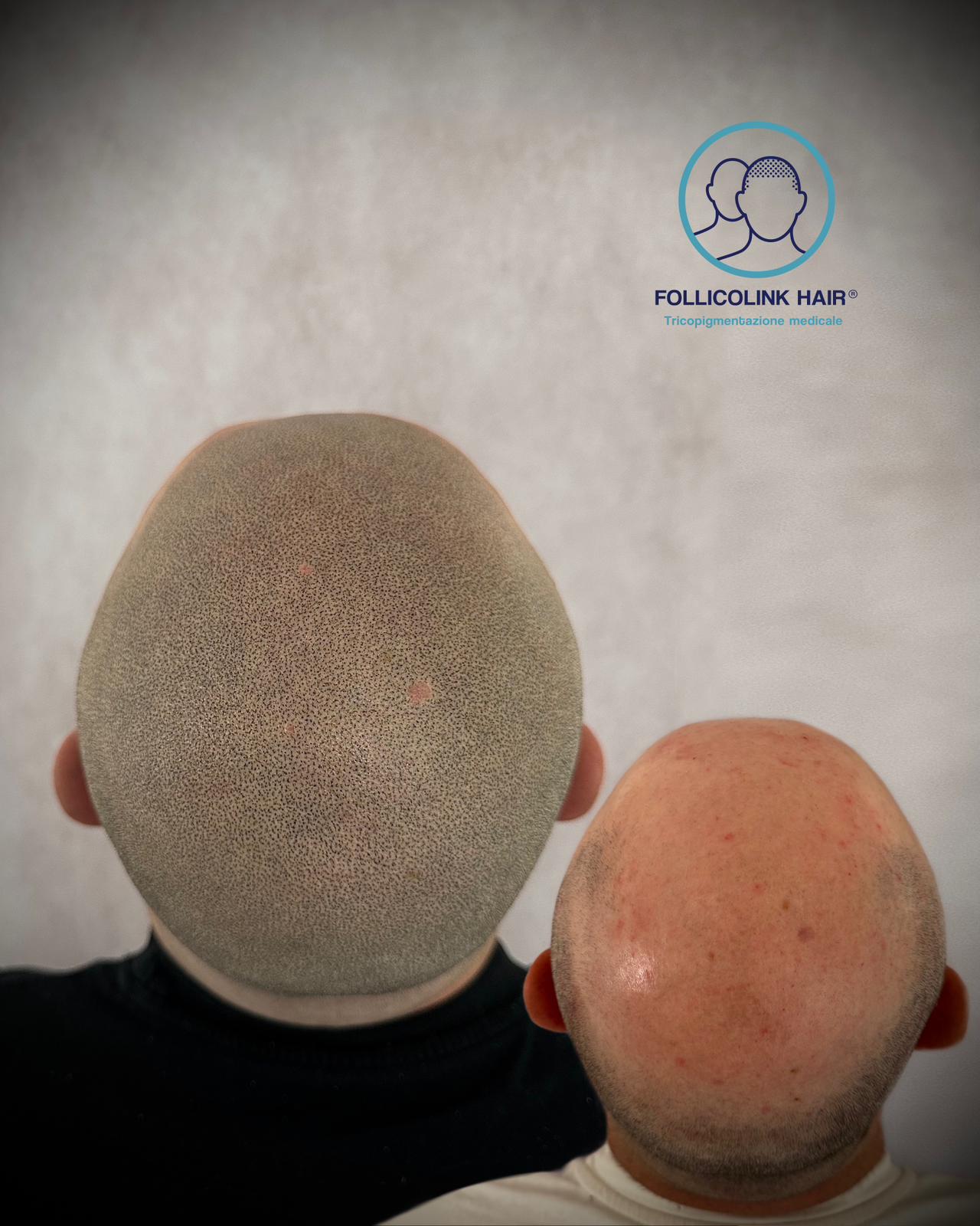 Effetto rasato - trattamento di tricopigmentazione a Catania Follicolink Hair