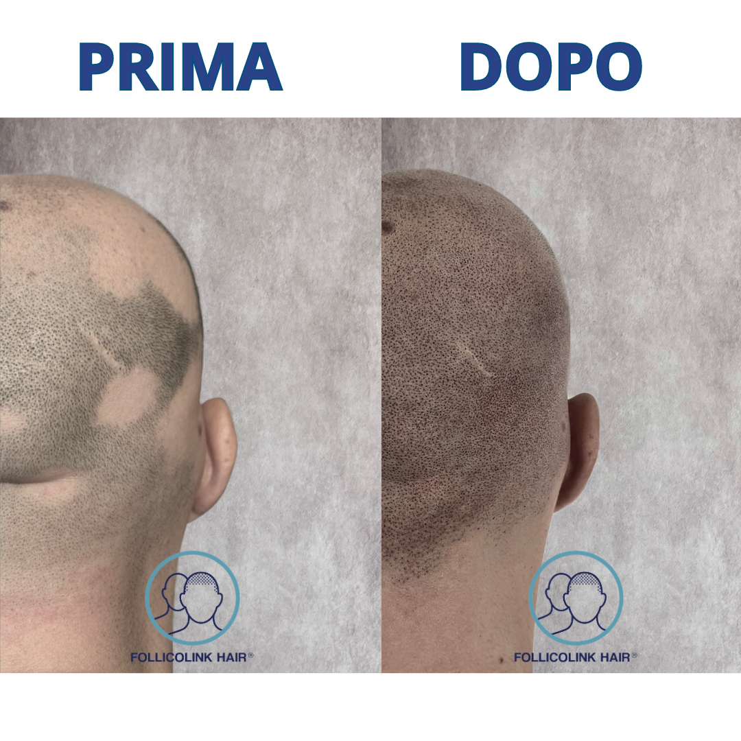 Alopecia areata