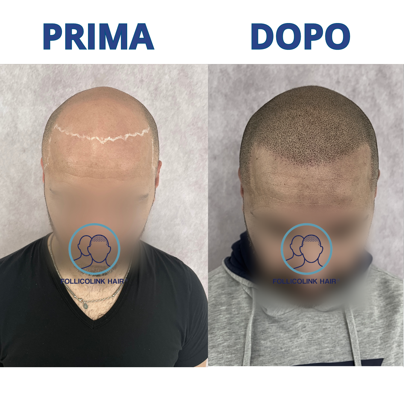 Effetto rasato